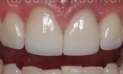 Thumbnail control image for Close-up of upper and lower teeth showing a gap between the upper front teeth with healthy gums.