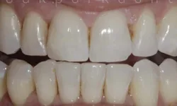 Thumbnail control image for Close-up of upper and lower human teeth showing natural dental alignment and tooth surface details.