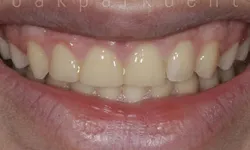 Thumbnail control image for Close-up of a partially smiling mouth showing yellowish teeth with visible gaps and uneven alignment.
