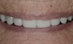 Thumbnail control image for Close-up of a smile showing white, even teeth and part of lips with natural skin texture.