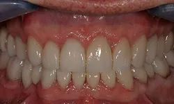 Thumbnail control image for Close-up of teeth showing tight occlusion with natural color and healthy gums under dental examination.