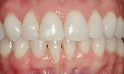 Thumbnail control image for Close-up of healthy, clean human teeth and gums showing dental alignment and natural texture.