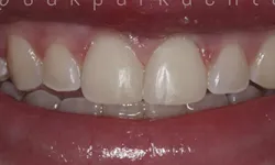 Thumbnail control image for Close-up of human teeth showing slightly gapped and clean upper front teeth and healthy gums.