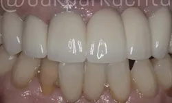 Thumbnail control image for Close-up of dental crowns covering upper front teeth showing a contrast with natural lower teeth.