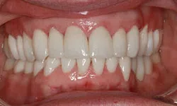 Thumbnail control image for Close-up of upper and lower teeth with noticeable dental crowding and irregular alignment