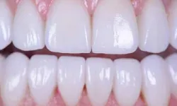 Thumbnail control image for Close-up of clean, healthy white teeth showing upper and lower front teeth and pink gums.