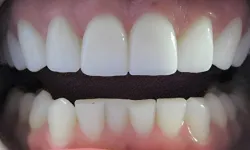 Thumbnail control image for Close-up of upper and lower teeth showing dental alignment and tooth structure details.