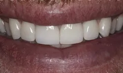 Thumbnail control image for Close-up of a smiling mouth showing white teeth and slightly dry lips.