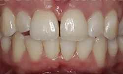 Thumbnail control image for Close-up of upper and lower teeth showing slight misalignment and spacing between front teeth.