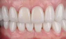 Thumbnail control image for Close-up of bright white teeth showing healthy gums and perfect dental alignment in a natural smile