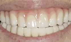 Thumbnail control image for Close-up of a bright, healthy smile showing clean white teeth and natural gums.