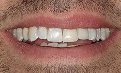 Thumbnail control image for Close-up of a man's mouth showing lips, teeth with discoloration and dental irregularities.