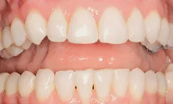 Thumbnail control image for Close-up of upper and lower teeth showing dental alignment and natural enamel texture in a smiling mouth.