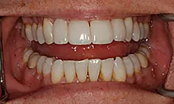 Thumbnail control image for Close-up of upper and lower teeth with dental retractor showing dental hygiene and teeth condition.