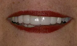 Thumbnail control image for Close-up of a smiling mouth with red lipstick and white, well-aligned teeth.