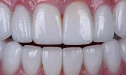 Thumbnail control image for Close-up of bright white, healthy upper and lower human teeth with gums visible in natural lighting