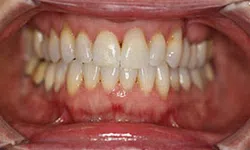 Thumbnail control image for Close-up of human teeth with visible plaque buildup and gum inflammation in an open mouth.