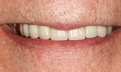 Thumbnail control image for Close-up of a smiling mouth showing clean, white dental implants or dentures on a light skin tone.