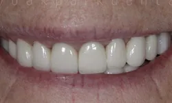 Thumbnail control image for Close-up of a smile showing clean, white, evenly aligned artificial dental veneers.