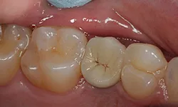 Thumbnail control image for Close-up of healthy molars and premolars showing chewing surfaces and gums inside a human mouth.