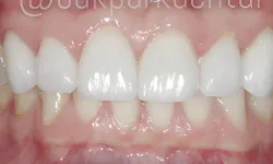 Thumbnail control image for Close-up of healthy upper and lower teeth showing clean white front teeth and pink gums.