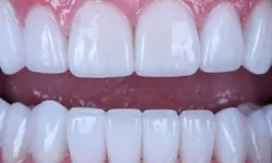 Thumbnail control image for Close-up of clean, white upper and lower teeth with healthy pink gums and natural shine
