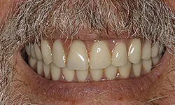 Thumbnail control image for Close-up of a smiling elderly man showing natural teeth and a gray mustache