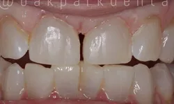 Thumbnail control image for Close-up of human teeth showing a gap between the front upper teeth and slight discoloration.