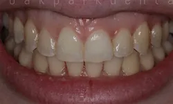 Thumbnail control image for Close-up of a smile showing slightly yellow, unevenly spaced teeth and healthy pink gums.