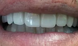 Thumbnail control image for Close-up of a smiling mouth showing clean, white teeth and natural lips with detailed skin texture.