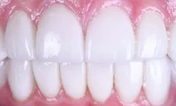 Thumbnail control image for Close-up of healthy, white teeth and pink gums showing clean dental hygiene and well-aligned teeth.