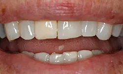 Thumbnail control image for Close-up of a mouth with uneven, discolored teeth and visible gaps between them.