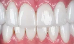 Thumbnail control image for Close-up of bright, clean, white teeth with healthy pink gums and glossy enamel finish, showing a perfect smile.