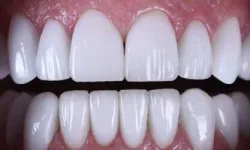 Thumbnail control image for Close-up of a healthy set of white upper and lower human teeth with gums visible in a smile.