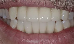 Thumbnail control image for Close-up of a smiling mouth showing clean, white, well-aligned adult teeth and mustache hairs above.