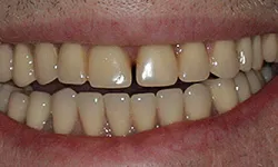 Thumbnail control image for Close-up of a smile showing natural teeth with a slight gap between front teeth and mild discoloration.