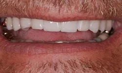 Thumbnail control image for Close-up of a smiling mouth showing clean white teeth and facial hair above and below the lips.