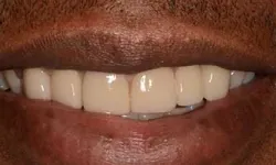 Thumbnail control image for Close-up of a smiling mouth showing white, well-aligned dental veneers on dark skin.