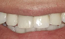 Thumbnail control image for Close-up of a smiling mouth showing clean, healthy white teeth and natural pink lips.