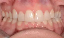 Thumbnail control image for Close-up of human upper and lower teeth showing alignment and healthy gums.