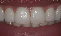 Thumbnail control image for Close-up of a bright, clean smile showing upper and lower teeth with healthy gums and lips.