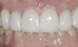 Thumbnail control image for Close-up of upper front teeth with dental crowns and natural lower teeth visible on gums.