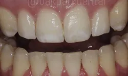 Thumbnail control image for Close-up of human teeth showing mild discoloration and gaps between upper front teeth.