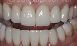 Thumbnail control image for Close-up of a person's mouth showing clean, white, perfectly aligned teeth and healthy gums.