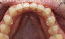 Thumbnail control image for Close-up of upper teeth with a clear dental retainer on the front teeth, gums visible.