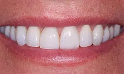 Thumbnail control image for Close-up of a bright, even smile with white teeth and healthy pink lips.