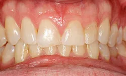 Thumbnail control image for Close-up of human teeth showing mild plaque buildup and healthy gums in a natural mouth.