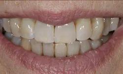 Thumbnail control image for Close-up of a smiling mouth showing slightly yellowed and worn teeth with natural texture and lips.