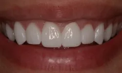 Thumbnail control image for Close-up of a bright, healthy smile showing clean, white teeth and natural lips.