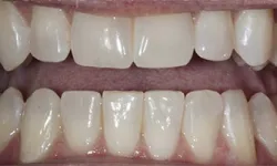 Thumbnail control image for Close-up of healthy natural upper and lower teeth with slight gaps and smooth texture under bright lighting